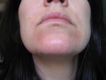 Day 6 peel 1